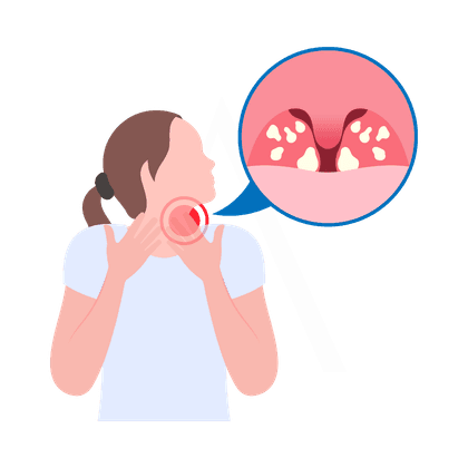 Angina en amandelontsteking