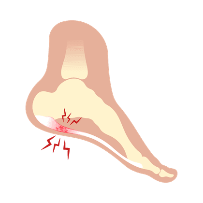 Espolón calcáneo (osteofito)