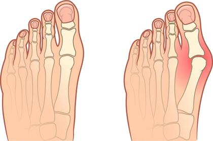 Alluce valgo (bunion)